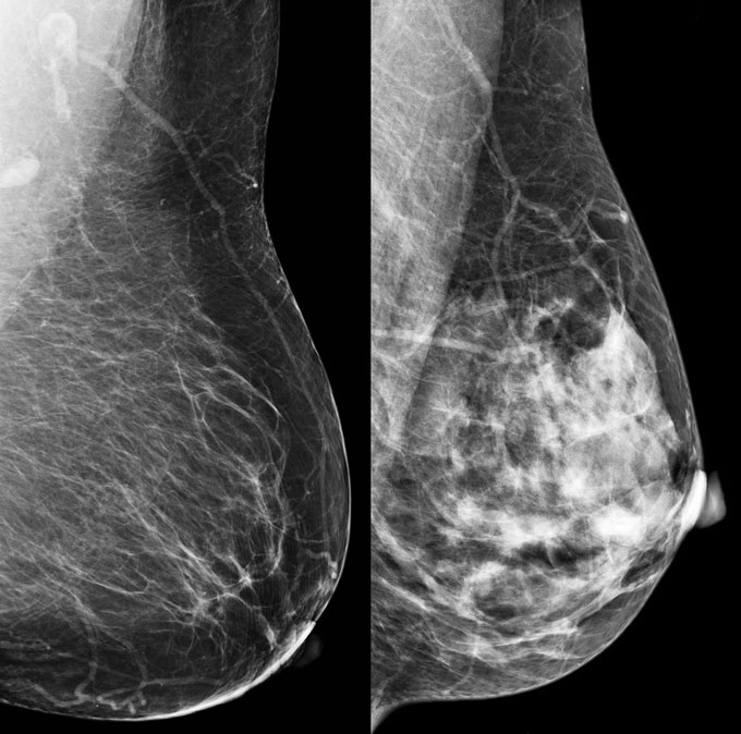 Two x-ray images of the breasts. The image on the left shows the fatty breast tissue as more transparent while the image on the right shows the denser breast tissue which appears white.